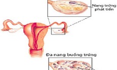 Bài thuốc trị bệnh buồng trứng đa nang