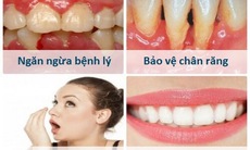 Phòng tránh cao răng và các bệnh liên quan