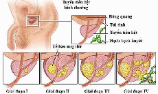 Ung thư tuyến tiền liệt không còn đáng sợ