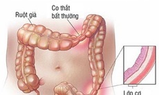 Cần trị dứt điểm hội chứng ruột kích thích