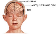 Máu tụ dưới màng cứng mạn tính ở người cao tuổi