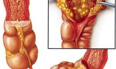 Cảnh giác với bệnh lao ruột