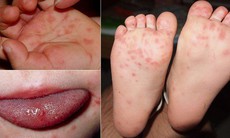 Hiểu đúng về chứng phát ban sau sốt ở trẻ