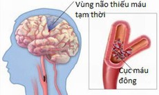 Chớ xem thường thiếu máu não cục bộ tạm thời