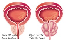 Quan hệ tình dục ở người bị phì đại tuyến tiền liệt