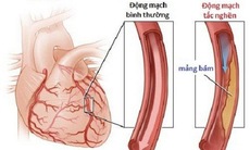 Bệnh mạch vành ở người cao tuổi