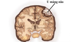 Những triệu chứng cảnh báo u màng não