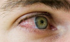 Có phải xuất huyết dưới kết mạc?