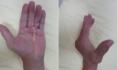 Làm gì khi bị đau co rút bàn tay?