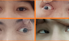 Phòng ngừa và điều trị lác mắt