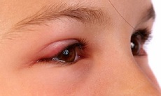 Chấn thương mắt do làm nông có thể gây mù