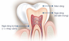 Phiền toái khi răng... nhạy cảm