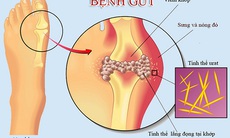 Đối phó với tăng acid uric máu ở người cao tuổi