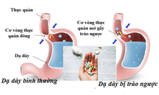 Thận trọng khi dùng ranitidine trị trào ngược dạ dày