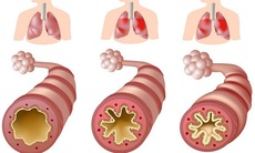 Cách kiểm soát bệnh hen suyễn hiệu quả