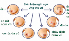 Những thực phẩm giúp ngăn ngừa ung thư vú