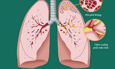Tìm ra căn nguyên gây bệnh viêm đường hô hấp mạn tính