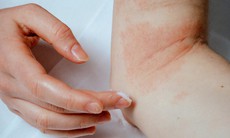 Cách giảm ngứa khi bị eczema