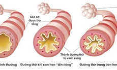 Hướng điều trị mới các bệnh viêm đường hô hấp mạn tính