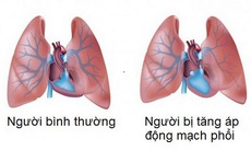 Tăng áp động mạch phổi và những lưu ý