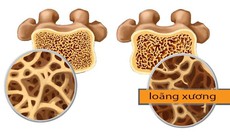 Nhận biết sớm bệnh loãng xương