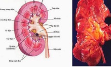 Dấu hiệu viêm cầu thận cấp