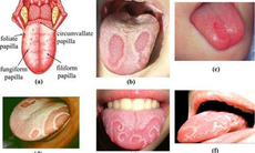 Xử trí viêm lưỡi bản đồ