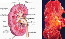 Bài thuốc hỗ trợ trị viêm cầu thận cấp