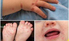 Trẻ mắc tay chân miệng chủ yếu do nuốt phải virus nhưng phòng bệnh không hề khó