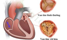 Biến chứng nguy hiểm của vôi hóa van tim