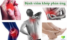 Chữa trị sớm viêm khớp phản ứng để tránh biến chứng