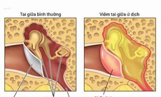 Tự điều trị viêm tai giữa, biến chứng khó lường