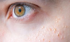 Có nên lẩy mụn thịt nhỏ dưới mí mắt?
