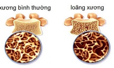 Thuốc loãng xương phải sử dụng lâu dài