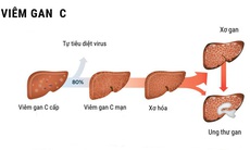 Tương tác giữa rượu và virus viêm gan C