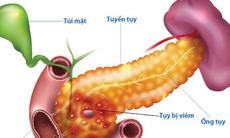 Biến chứng dễ gặp của viêm tụy mạn tính