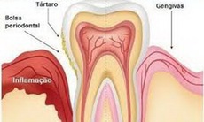 Chảy máu chân răng có thể gây mất răng