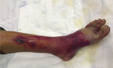 Suýt mất chân vì sốc nhiễm trùng da