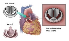 Cứu sống bệnh nhân kẹt van 2 lá biến chứng phù phổi cấp