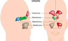 Cách xử trí khi bị chảy máu cam