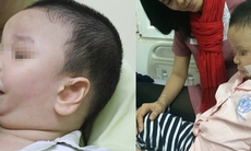 Phẫu thuật kéo giãn xương hàm điều trị bệnh nhi bị nhiều dị tật phức tạp