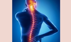Vẹo cột sống - vì sao cần được phát hiện sớm?