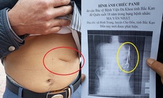 Xử lý thông tin bỏ quên kéo trong bụng bệnh nhân 18 năm tại Bắc Kạn