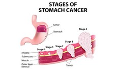 Mỗi năm có trên 14.000 ca mắc mới ung thư dạ dày tại Việt Nam