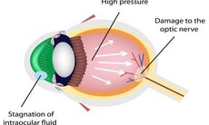 Glôcôm – Những điều cần biết