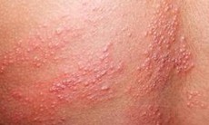 Zona thần kinh: Càng căng thẳng càng đau đớn