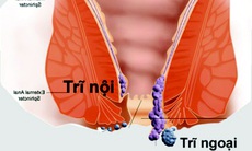 Điều trị dứt điểm bệnh trĩ:  Khó hay dễ?