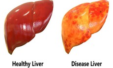 Bệnh nhân xơ gan nên ăn và nên tránh thực phẩm gì