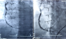 Quảng Ninh lần đầu tiên thực hiện thành công  can thiệp đặt stent cầu nối tĩnh mạch hiển