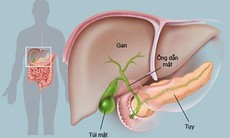 Quá nhiều dầu mỡ, chất đạm, rượu bia, cấp cứu vì viêm tụy cấp